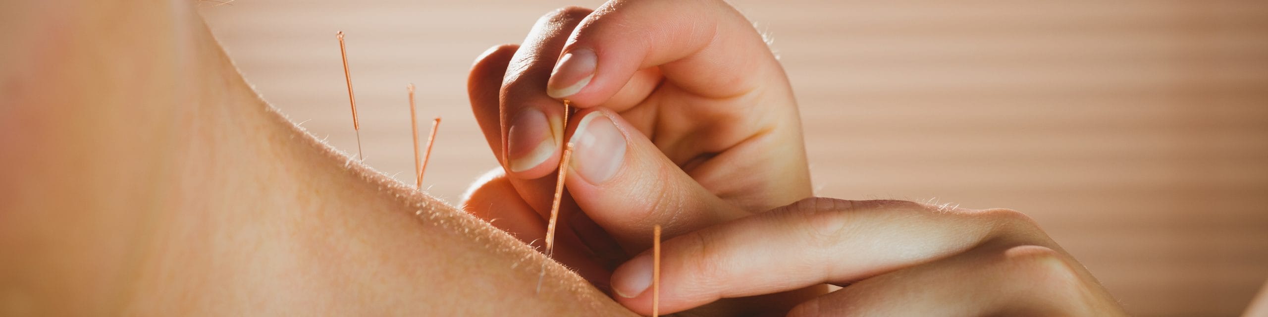 Akupunktur als Alternative zur Schmerzbehandlung